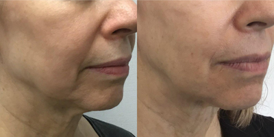 Case 10281 - 65-74 year old woman treated with Sofwave, Ultherapy, Skin Tightening