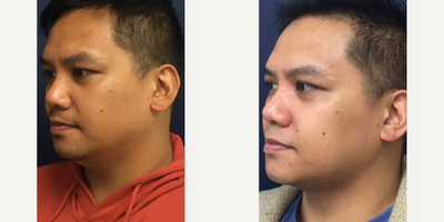 Case 10282 - Man treated with Liposuction, FaceTite, Ultherapy