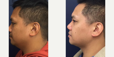 Case 10283 - Man treated with Liposuction, FaceTite, Ultherapy