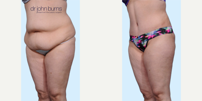 Case 1031 - Woman treated with Tummy Tuck