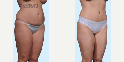 Case 1032 - Woman treated with Tummy Tuck