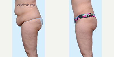 Case 1033 - Woman treated with Tummy Tuck