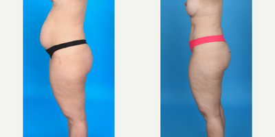 Case 1034 - 35-44 year old woman treated with Tummy Tuck, Diastasis Recti Repair, Mini Tummy Tuck, Drainless Tummy Tuck, Liposculpture, Lipo