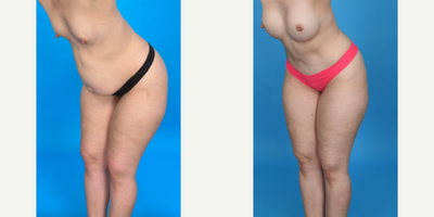 Case 1036 - 35-44 year old woman treated with Tummy Tuck, Diastasis Recti Repair, Mini Tummy Tuck, Drainless Tummy Tuck, Liposculpture, Lipo