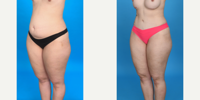 Case 1037 - 35-44 year old woman treated with Tummy Tuck, Diastasis Recti Repair, Mini Tummy Tuck, Drainless Tummy Tuck, Liposculpture, Lipo