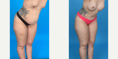 Case 1038 - 35-44 year old woman treated with Tummy Tuck, Diastasis Recti Repair, Mini Tummy Tuck, Drainless Tummy Tuck, Liposculpture, Lipo