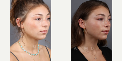 Case: 10381 - before and after photo of Woman treated with Rhinoplasty, Septoplasty by James C. Marotta, MD