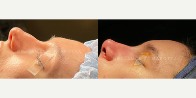 Case: 10383 - before and after photo of Woman treated with Rhinoplasty, Septoplasty by James C. Marotta, MD