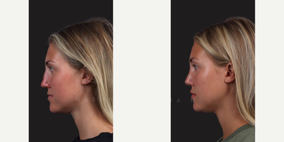 Case: 10385 - before and after photo of Woman treated with Rhinoplasty, Septoplasty by James C. Marotta, MD