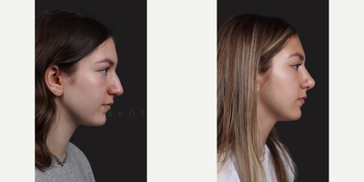 Case: 10386 - before and after photo of Woman treated with Rhinoplasty, Septoplasty by James C. Marotta, MD