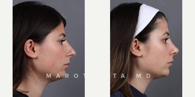 Case: 10389 - before and after photo of Woman treated with Septoplasty by James C. Marotta, MD