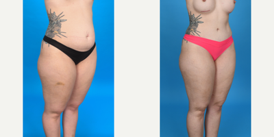 Case 1039 - 35-44 year old woman treated with Tummy Tuck, Diastasis Recti Repair, Mini Tummy Tuck, Drainless Tummy Tuck, Liposculpture, Lipo