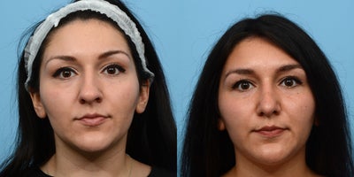 Case 10390 - 25-34 year old woman treated with Septoplasty