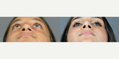 Case 10395 - Woman treated with Septoplasty