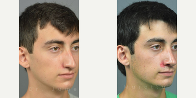 Case 10396 - Man treated with Rhinoplasty, Septoplasty