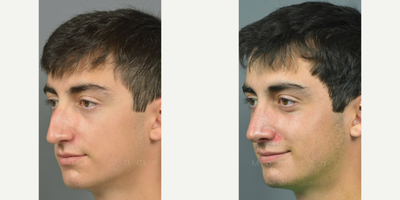 Case 10397 - Man treated with Rhinoplasty, Septoplasty