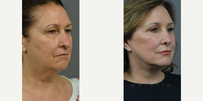 Case 10398 - Woman treated with Septoplasty