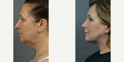 Case 10399 - Woman treated with Septoplasty