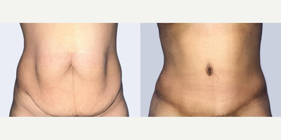 Case 104 - Woman treated with Tummy Tuck