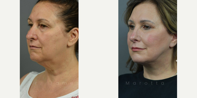 Case 10400 - Woman treated with Septoplasty