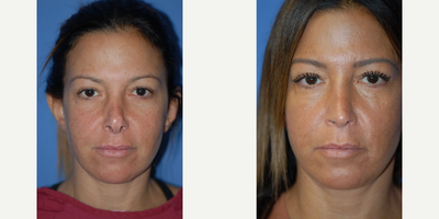 Case 10401 - Woman treated with Septoplasty and Revision rhinoplasty