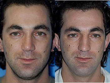 Case 10403 - Man treated with Septoplasty and Rhinoplasty