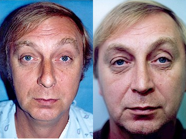 Case 10404 - Man treated with Septoplasty and Rhinoplasty