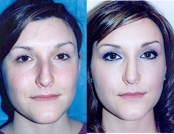 Case 10405 - Woman treated with Septoplasty and Rhinoplasty