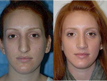 Case 10406 - Woman treated with Septoplasty and Rhinoplasty