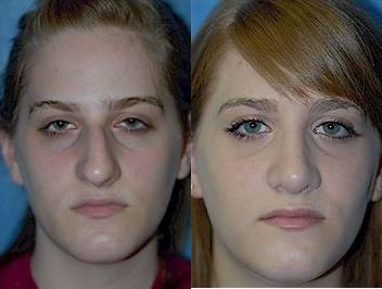 Case 10407 - Woman treated with Septoplasty and Rhinoplasty