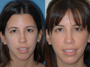 Case 10408 - Woman treated with Septoplasty and Rhinoplasty