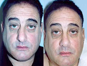 Case 10409 - Man treated with Septoplasty