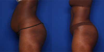 Case 1041 - 25-34 year old woman treated with Tummy Tuck