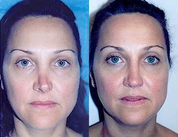 Case 10410 - 32 year old woman treated with Septoplasty