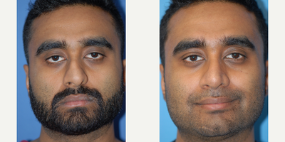 Case 10411 - 25-34 year old man treated with Septoplasty