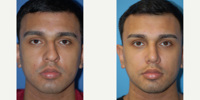 Case 10412 - 25-34 year old man treated with Septoplasty