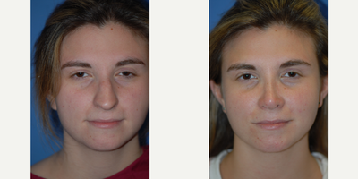 Case 10414 - 25-34 year old woman treated with Septoplasty