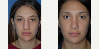 Case 10415 - 25-34 year old woman treated with Septoplasty