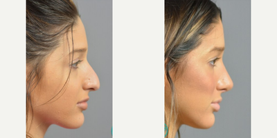 Case 10417 - Woman treated with Septoplasty