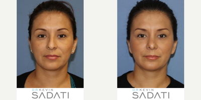 Case 10419 - Orange County SeptoRhinoplasty Procedure