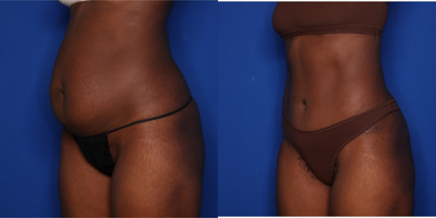 Case 1042 - 25-34 year old woman treated with Tummy Tuck