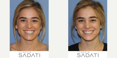 Case 10420 - SeptoRhinoplasty procedure on an Orange County Female