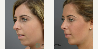 Case 10421 - Woman treated with Rhinoplasty, Septoplasty