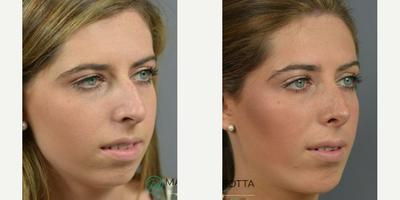 Case 10422 - Woman treated with Rhinoplasty, Septoplasty