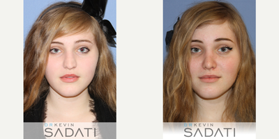 Case 10423 - Open Septo-Rhinoplasty Procedure on Orange County Female