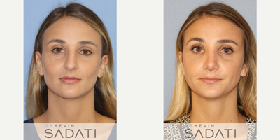 Case 10424 - Septo-Rhinoplasty Procedure on Orange County Female