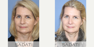 Case 10425 - Septo-Rhinoplasty on 55 Yr Old Orange County Female