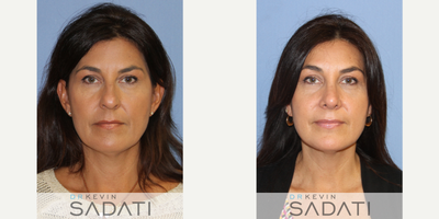 Case 10426 - Septo-Rhinoplasty on 50 Yr Old Orange County Female