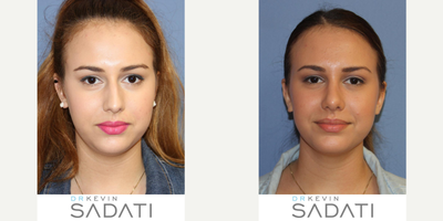 Case 10427 - Teenage Septorhinoplasty