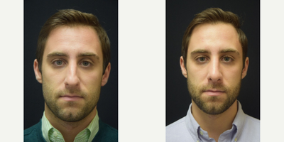 Case 10429 - 25-34 year old man treated with Septoplasty and Rhinoplasty